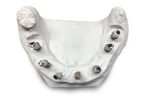 Sistema-implanto-protesico_04